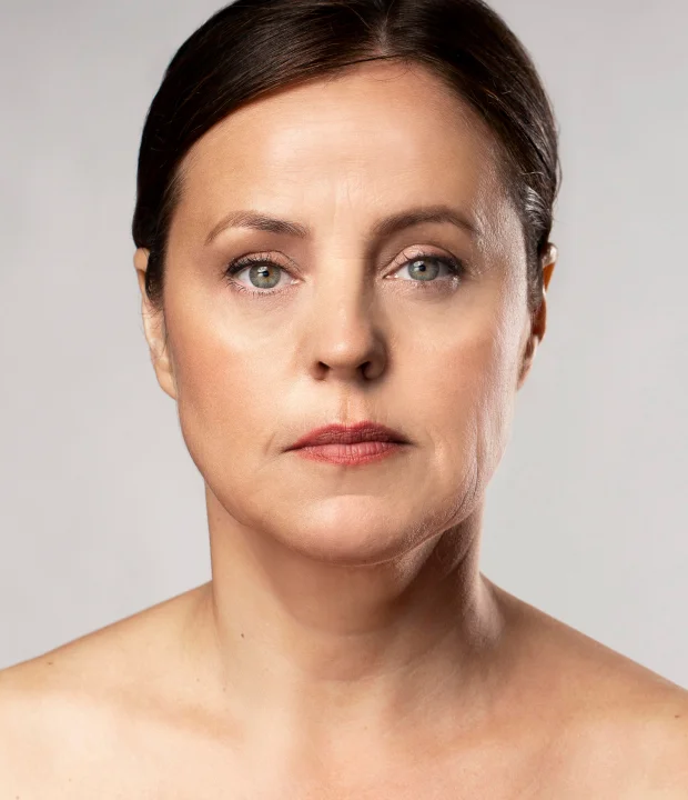 After aesthetic treatment result at Lumara Aesthetic Clinic