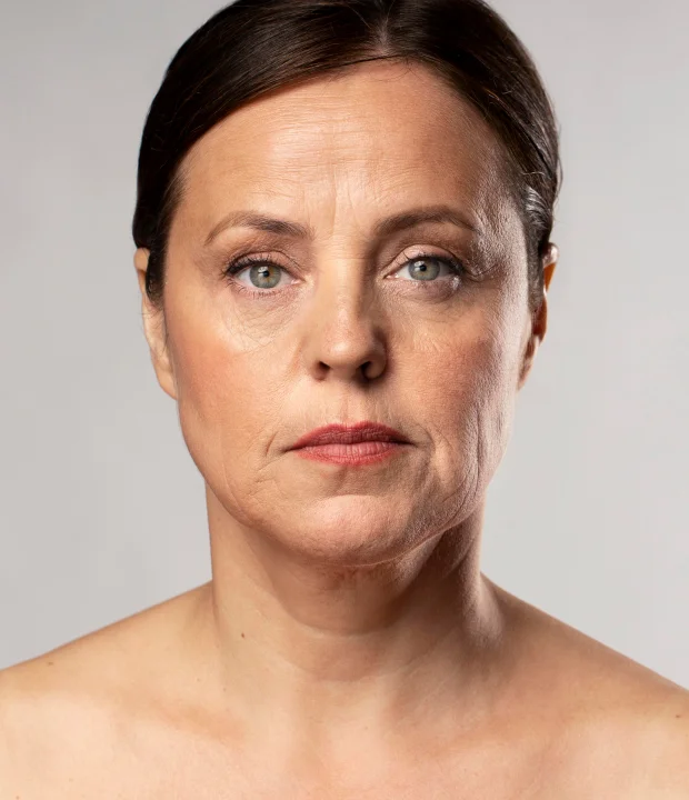 Before aesthetic treatment result at Lumara Aesthetic Clinic